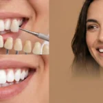 Comparativa visual en primer plano de un tratamiento de carillas dentales y blanqueamiento junto a una mujer con sonrisa natural y brillante.