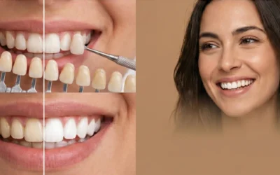 ¿Carillas o Blanqueamiento Dental? Cuál elegir para mejorar tu sonrisa